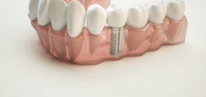 In unserer Zahnarzt Praxis in Mutlangen setzen wir modernste Implantate ein